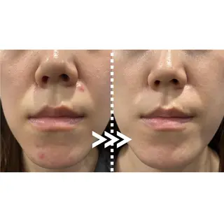 肌質改善専門 ハーブ /毛穴洗浄 リエイトのエステ・リラクイメージ