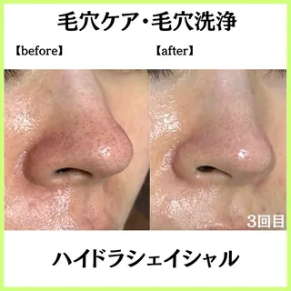 小顔ハーブピーリング 美容鍼/毛穴洗浄のエステ・リラクイメージ