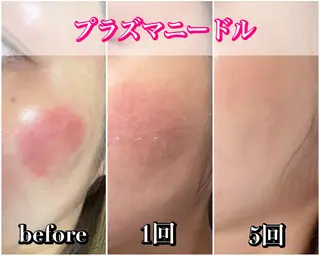 毛穴レス ハーブ＆ ワックス脱毛×光脱毛のエステ・リラクイメージ