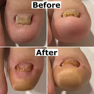 Mellow nail所属・巻爪無料モデル募集 ✨🦶MEGUMIのネイルデザイン