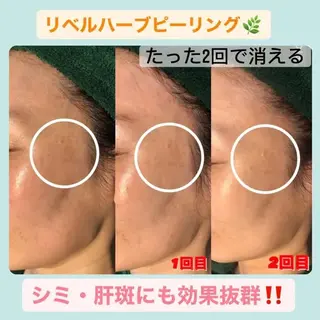 ハーブピーリング専門店HERBERRY難波心斎橋店所属・ハーブピーリング専門 HERBERRY冨永のエステ・リラクイメージ