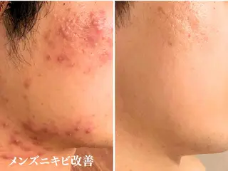 ニキビ特化型エステ 🍓最短で肌質改善のエステ・リラクイメージ