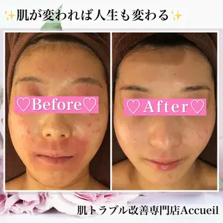 ミディアム カラー パーマ ヘアアレンジ メンズ キッズ ネイル マツエク・マツパ アイブロウ ニキビ・肌質改善専門 ♡人生が変わるサロンのエステ・リラクイメージ