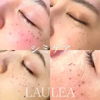シミケア/ハーブピーリング/脱毛/小顔フェイシャル/ハーブ温浴　LAULEA所属・素肌をキレイに ラウレア🌼Hayaのエステ・リラクイメージ