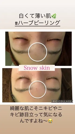 ニキビ/肌質改善専門 Snow skinのエステ・リラクイメージ