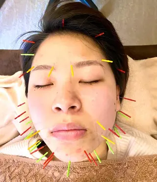 メンズ Acupuncture  salon LINOA リノア鍼灸院所属・ヘッドスパ鍼/小顔鍼 耳ツボ 　LINOAのエステ・リラクイメージ