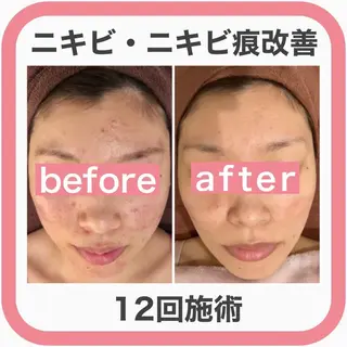 ニキビ跡改善専門🔥 医療にはできない改善のエステ・リラクイメージ