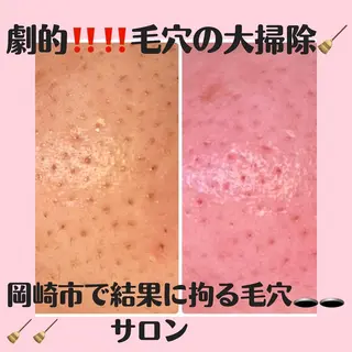 小顔・毛穴/ニキビ/ ハーブピーリング専門のエステ・リラクイメージ