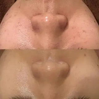 都内で出来る肌管理！ 最短ニキビ改善のエステ・リラクイメージ