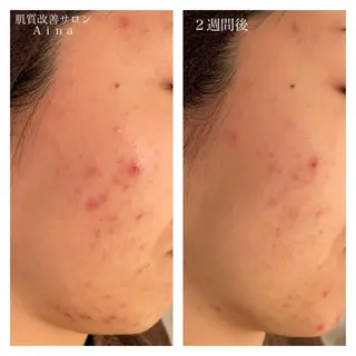 ショート カラー パーマ ヘアアレンジ メンズ キッズ ネイル マツエク・マツパ ニキビ跡専門サロン Ainaのエステ・リラクイメージ