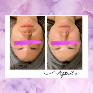 ☆痩身/小顔☆ ハイパーナイフexのエステ・リラクイメージ