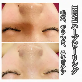 Chalon所属・REVI取扱・肌悩み 毛穴Chalonのエステ・リラクイメージ