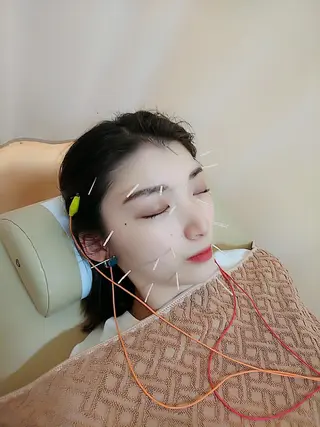 リフトアップ・たるみ ☆美容鍼小顔矯正のその他イメージ