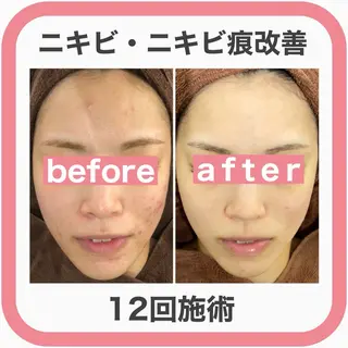 学生ニキビ改善🍀 優しい肌質改善のエステ・リラクイメージ
