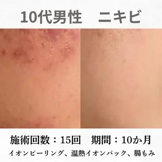 重度ニキビ専門🌷 ダウンタイムなしのエステ・リラクイメージ