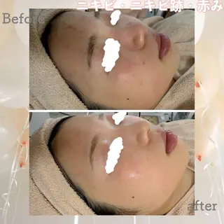 ニキビ&跡改善サロン オーナー光木のエステ・リラクイメージ