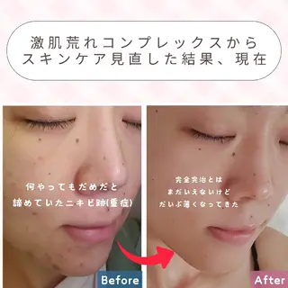 痩身ハーブピーリング 筋膜リリース☆B&Hのエステ・リラクイメージ