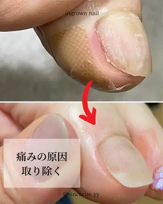 ネイル 深爪・巻き爪 専門サンセリテのネイルデザイン