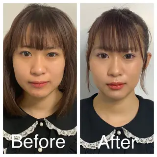 医療提携Ruby所属・医療提携Ruby小顔 ハーブピーリングのその他イメージ