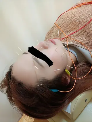 リフトアップ・たるみ ☆美容鍼小顔矯正のその他イメージ