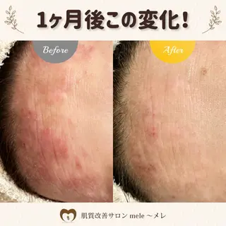 ニキビケア/毛穴/ 赤み/自信の肌✨森園のエステ・リラクイメージ