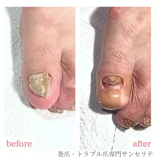 ネイル 深爪・巻き爪 専門サンセリテのネイルデザイン