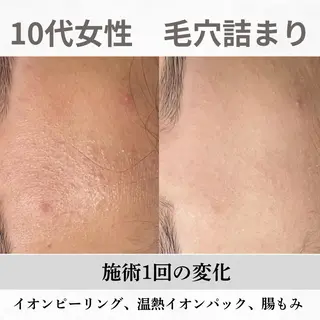 重度ニキビ専門🌷 ダウンタイムなしのエステ・リラクイメージ