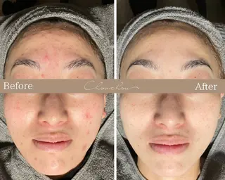 beauty & health salon Chou chou所属・ニキビ・毛穴🌿肌を 育てるララピール✨のエステ・リラクイメージ