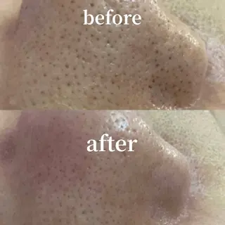 hitohana所属・毛穴/いちご鼻/小顔 /hitohanaのエステ・リラクイメージ