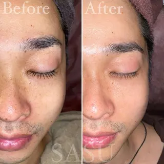 メンズ アイブロウ 即小顔♥️美容鍼× ハーブピーリングのその他イメージ