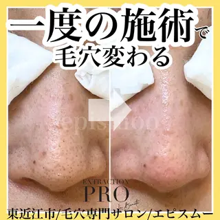 epismoo 脱毛/HBL/毛穴の眉毛・アイブロウイメージ