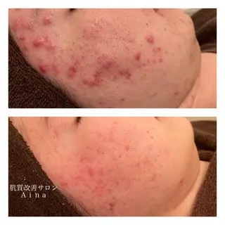 ミディアム カラー パーマ ヘアアレンジ メンズ キッズ ネイル マツエク・マツパ ニキビ跡専門サロン Ainaのエステ・リラクイメージ