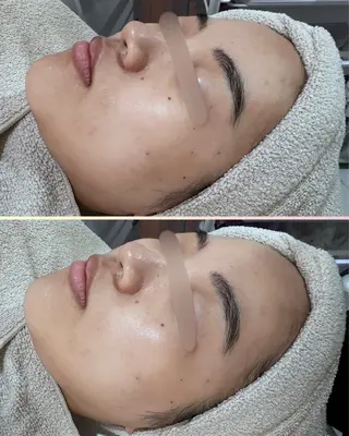 |ピーリング・毛穴| soina神楽坂のエステ・リラクイメージ