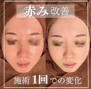 学生ニキビ改善🍀 優しい肌質改善のエステ・リラクイメージ