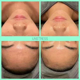 ☆痩身/小顔☆ ハイパーナイフexのエステ・リラクイメージ