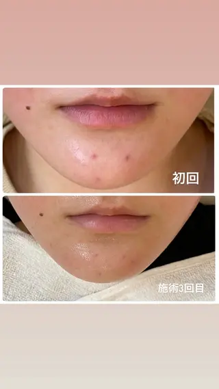 ハーブピーリング🌿 脱毛🧡ヘッドスパのエステ・リラクイメージ