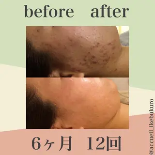 ミディアム パーマ ヘアアレンジ メンズ キッズ ネイル マツエク・マツパ ニキビ・肌質改善専門 ♡人生が変わるサロンのエステ・リラクイメージ