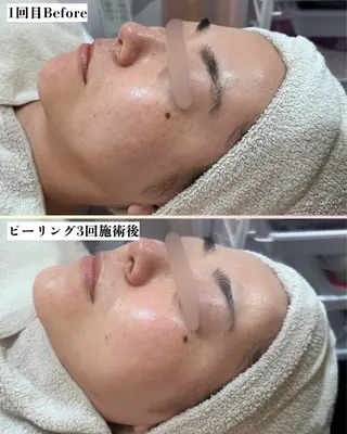 |ピーリング・毛穴| soina神楽坂のエステ・リラクイメージ