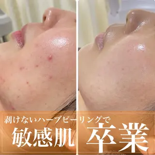 ニキビ・毛穴改善 🌿ハーブピーリングのエステ・リラクイメージ