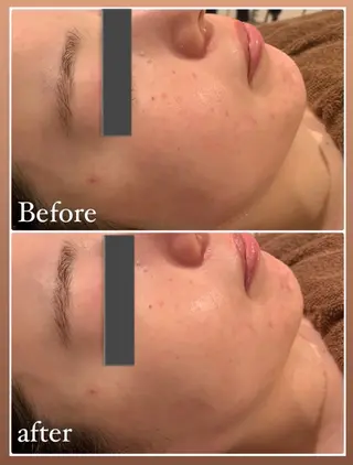 肌質改善ハーブピー リング🌿RINAのエステ・リラクイメージ