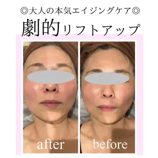 小顔・リフトアップ/ 奈緒美のエステ・リラクイメージ