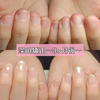 ネイル 深爪矯正/爪育成ケア manie nailのネイルデザイン