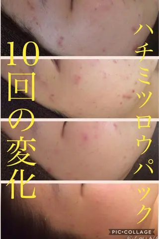 ニキビ・肌質改善専門 ♡人生が変わるサロンのエステ・リラクイメージ