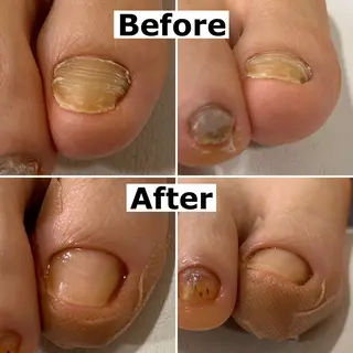 ネイル Mellow nail所属・巻爪無料モデル募集 ✨🦶MEGUMIのネイルデザイン