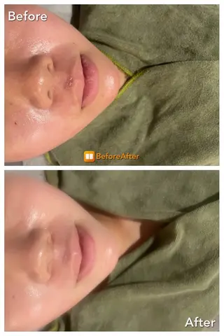 Meupニキビ専門店 背中/ハーブ/肌管理のその他イメージ