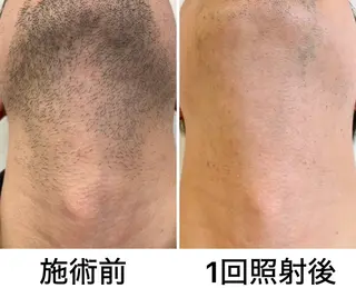 メンズ RESON 調布店所属・都度払いの脱毛サロン RESONのエステ・リラクイメージ