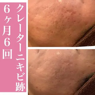 学生ニキビ改善🍀 優しい肌質改善のエステ・リラクイメージ