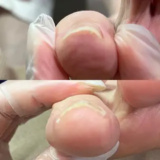 ネイル 自爪育成・巻き爪 補正講師　津蔵のネイルデザイン