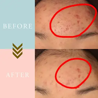 ニキビケア/毛穴/ 赤み/自信の肌✨森園のエステ・リラクイメージ