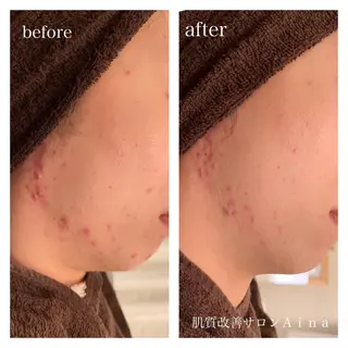 ロング カラー パーマ ヘアアレンジ メンズ キッズ ネイル マツエク・マツパ ニキビ跡専門サロン Ａｉｎａのエステ・リラクイメージ